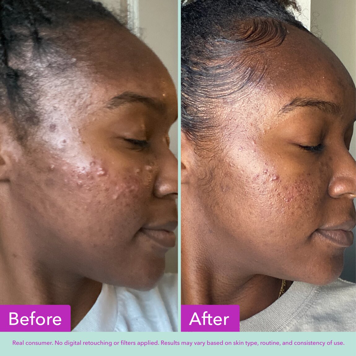 acne-foaming-cleanser-u5 zb_p.jpg