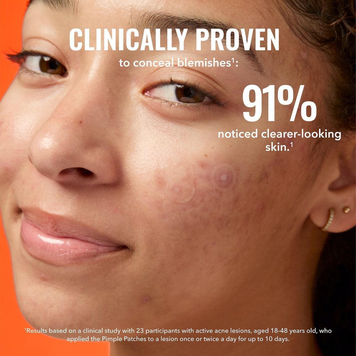 pimple-patches-g1 zb_p.jpg